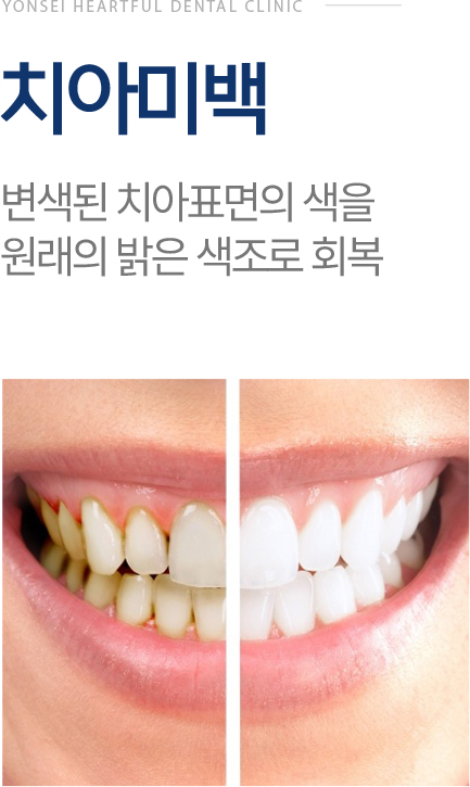 치아미백